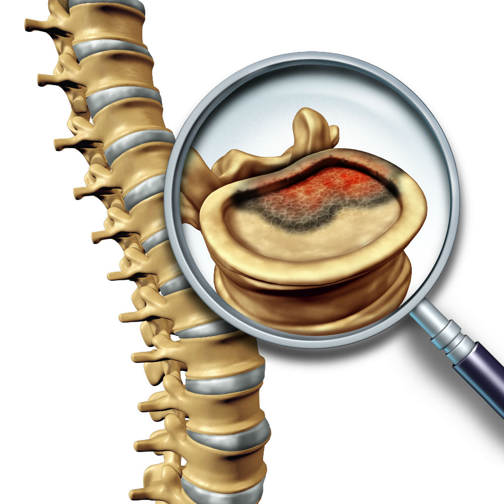 Spine-Tumors