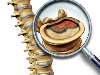 Spine-Tumors